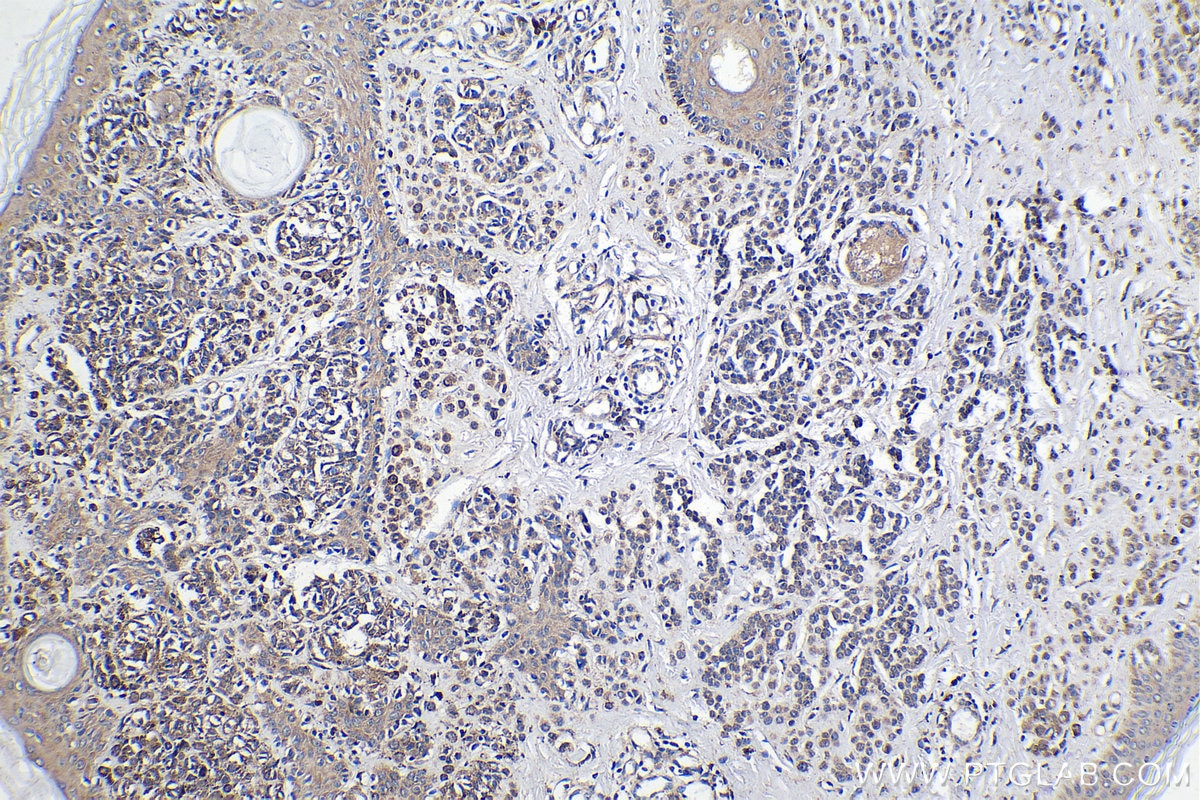 Immunohistochemistry (IHC) staining of human malignant melanoma tissue using MAGEC2 Polyclonal antibody (10280-1-AP)