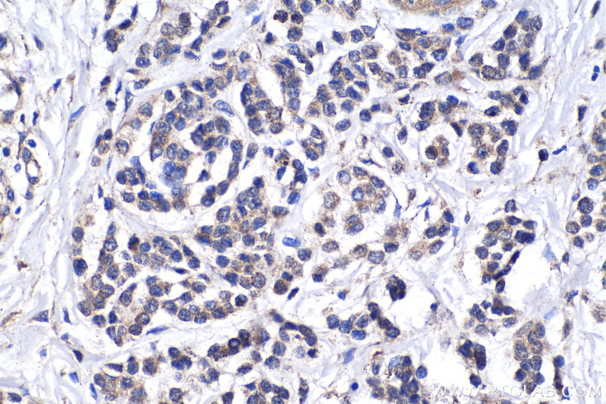 Immunohistochemistry (IHC) staining of human malignant melanoma tissue using MAGEC2 Polyclonal antibody (10280-1-AP)