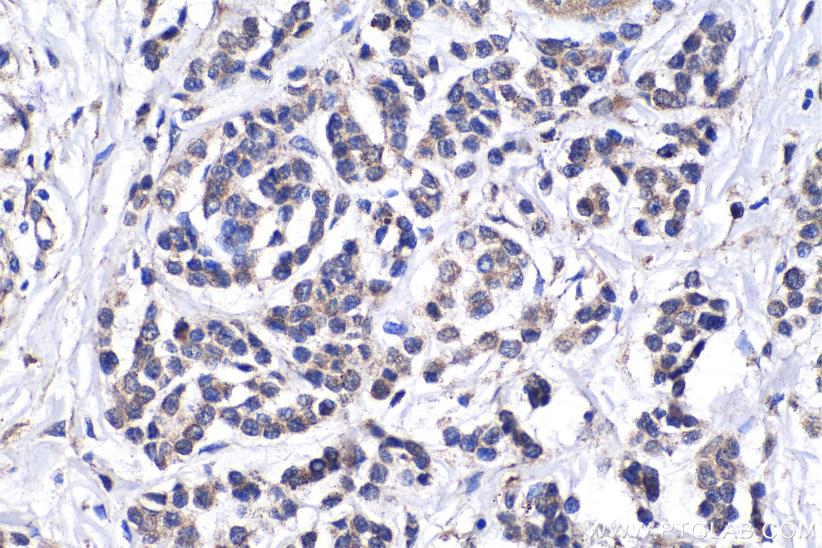 IHC staining of human malignant melanoma using 10280-1-AP