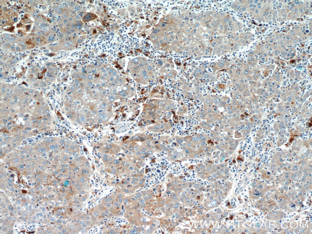 Immunohistochemistry (IHC) staining of human liver cancer tissue using MAGEC2 Monoclonal antibody (60040-1-Ig)