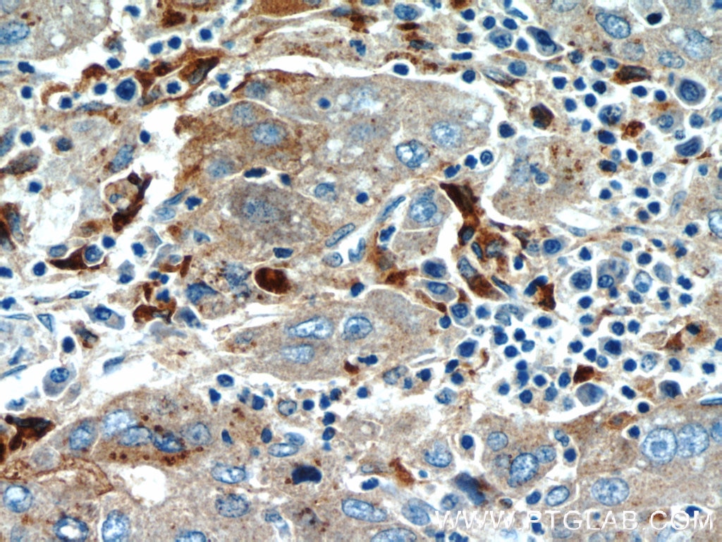 Immunohistochemistry (IHC) staining of human liver cancer tissue using MAGEC2 Monoclonal antibody (60040-1-Ig)