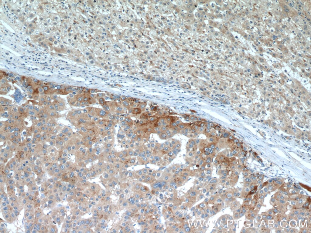 Immunohistochemistry (IHC) staining of human liver cancer tissue using MAGEC2 Monoclonal antibody (60040-1-Ig)