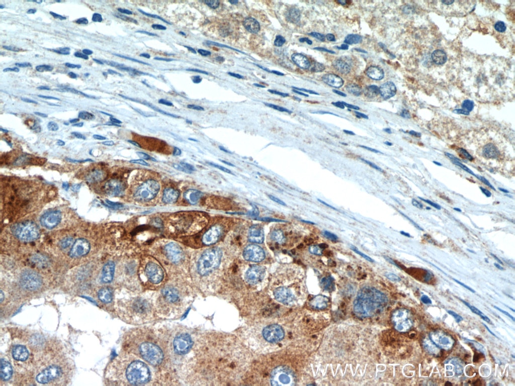 Immunohistochemistry (IHC) staining of human liver cancer tissue using MAGEC2 Monoclonal antibody (60040-1-Ig)