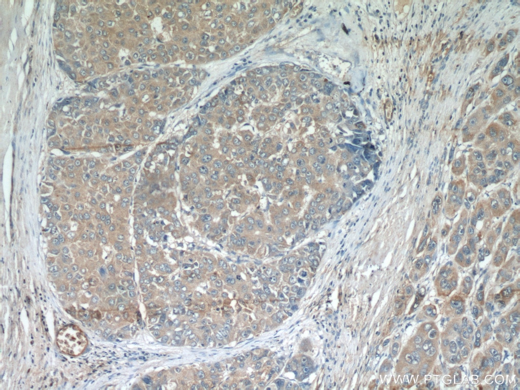 Immunohistochemistry (IHC) staining of human liver cancer tissue using MAGEC3 Polyclonal antibody (21491-1-AP)