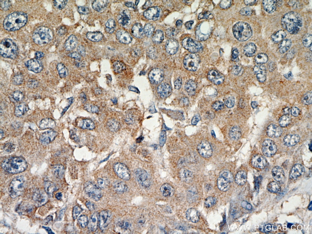 Immunohistochemistry (IHC) staining of human liver cancer tissue using MAGEC3 Polyclonal antibody (21491-1-AP)