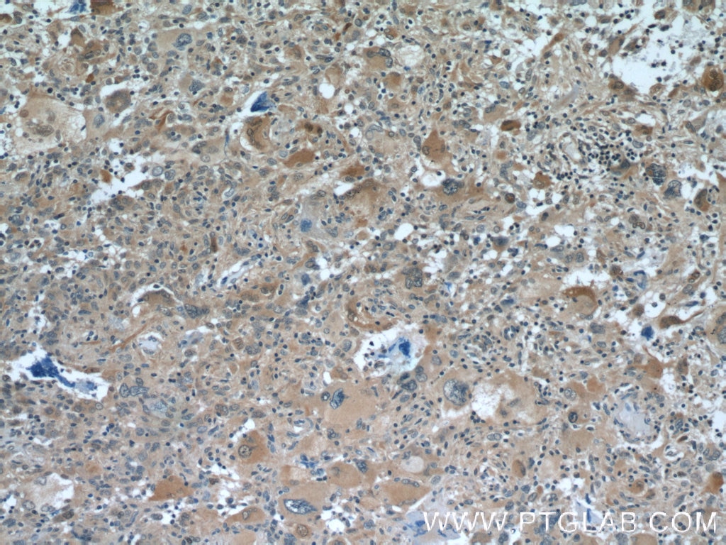 Immunohistochemistry (IHC) staining of human gliomas tissue using MAGED1 Polyclonal antibody (11539-1-AP)