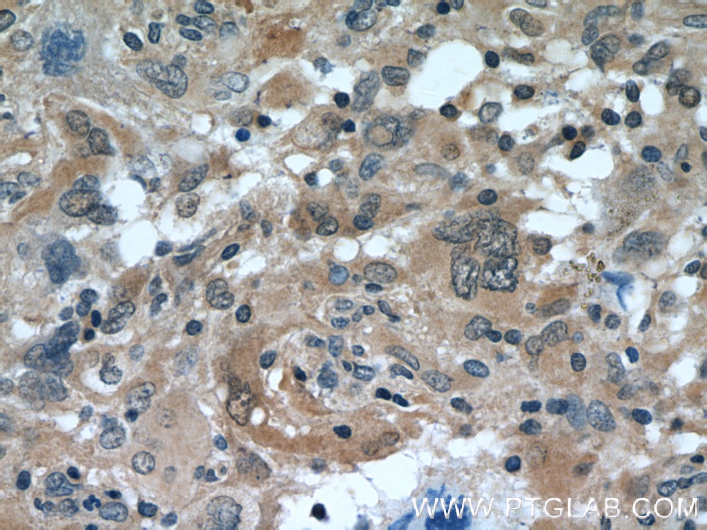 Immunohistochemistry (IHC) staining of human gliomas tissue using MAGED1 Polyclonal antibody (11539-1-AP)