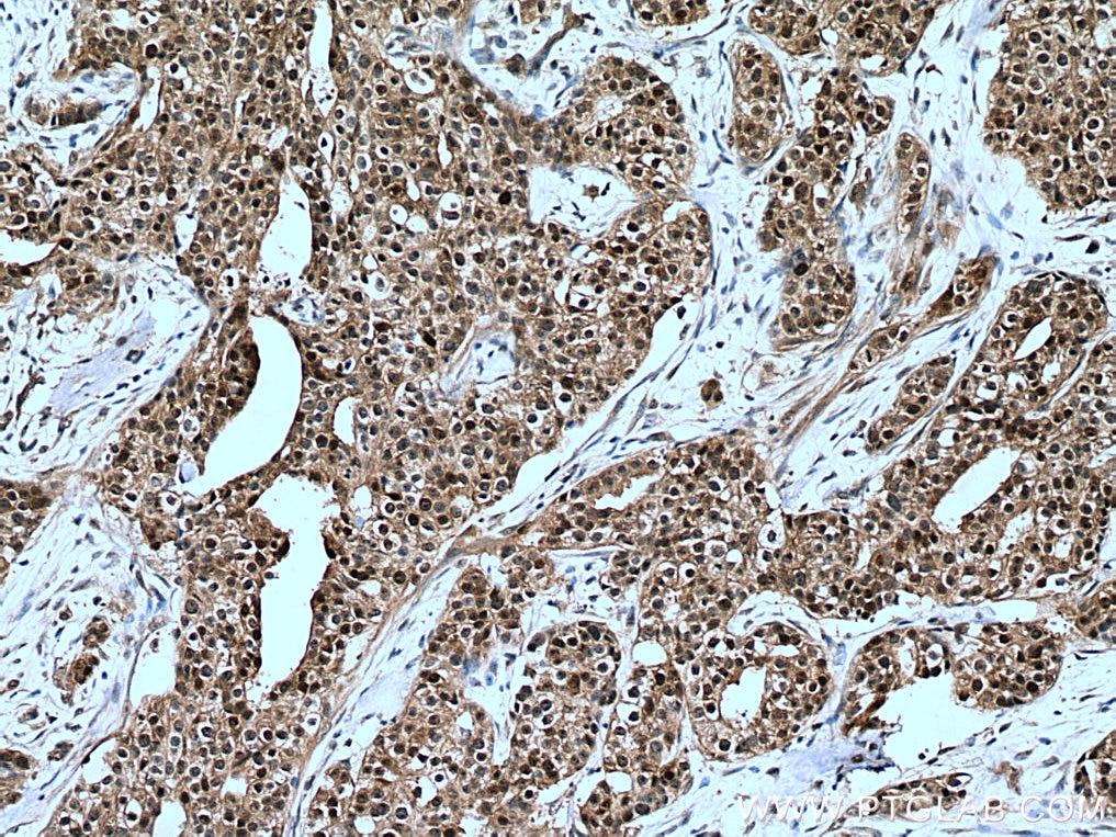 Immunohistochemistry (IHC) staining of human breast cancer tissue using MAGED2 Polyclonal antibody (15252-1-AP)