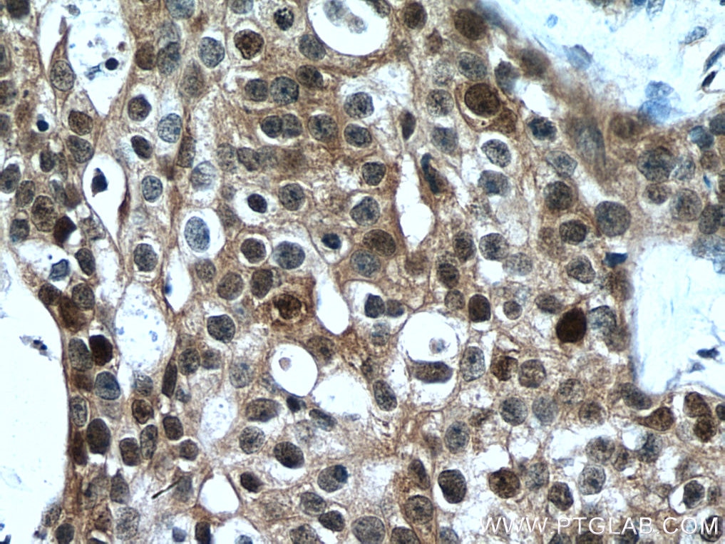 Immunohistochemistry (IHC) staining of human breast cancer tissue using MAGED2 Polyclonal antibody (15252-1-AP)