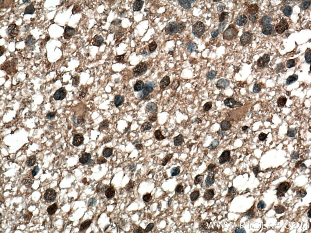 Immunohistochemistry (IHC) staining of human gliomas tissue using MAGED4 Polyclonal antibody (16809-1-AP)