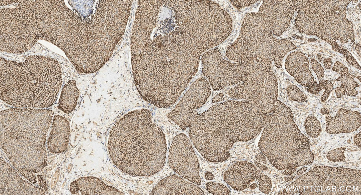 Immunohistochemistry (IHC) staining of human breast cancer tissue using MAGEF1 Polyclonal antibody (24105-1-AP)