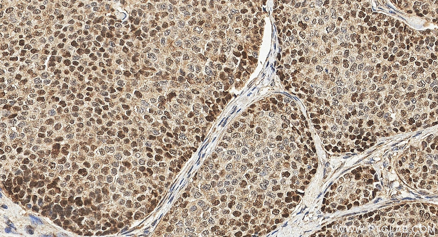 Immunohistochemistry (IHC) staining of human breast cancer tissue using MAGEF1 Polyclonal antibody (24105-1-AP)
