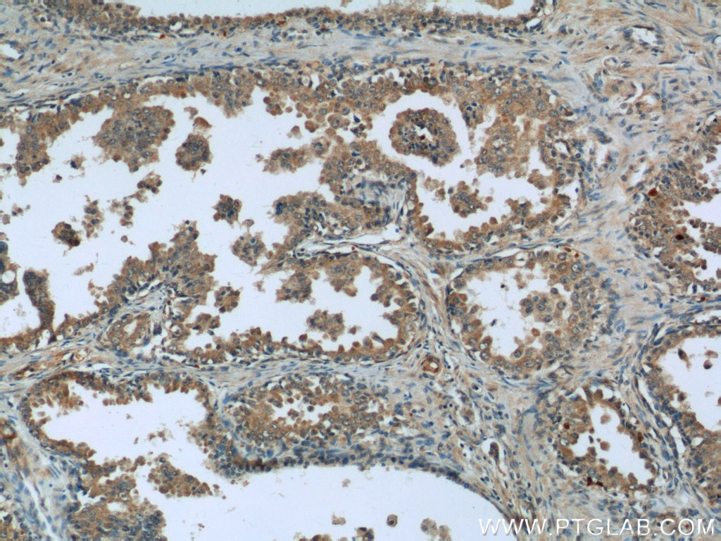 Immunohistochemistry (IHC) staining of human prostate cancer tissue using MAGEH1 Polyclonal antibody (12424-1-AP)