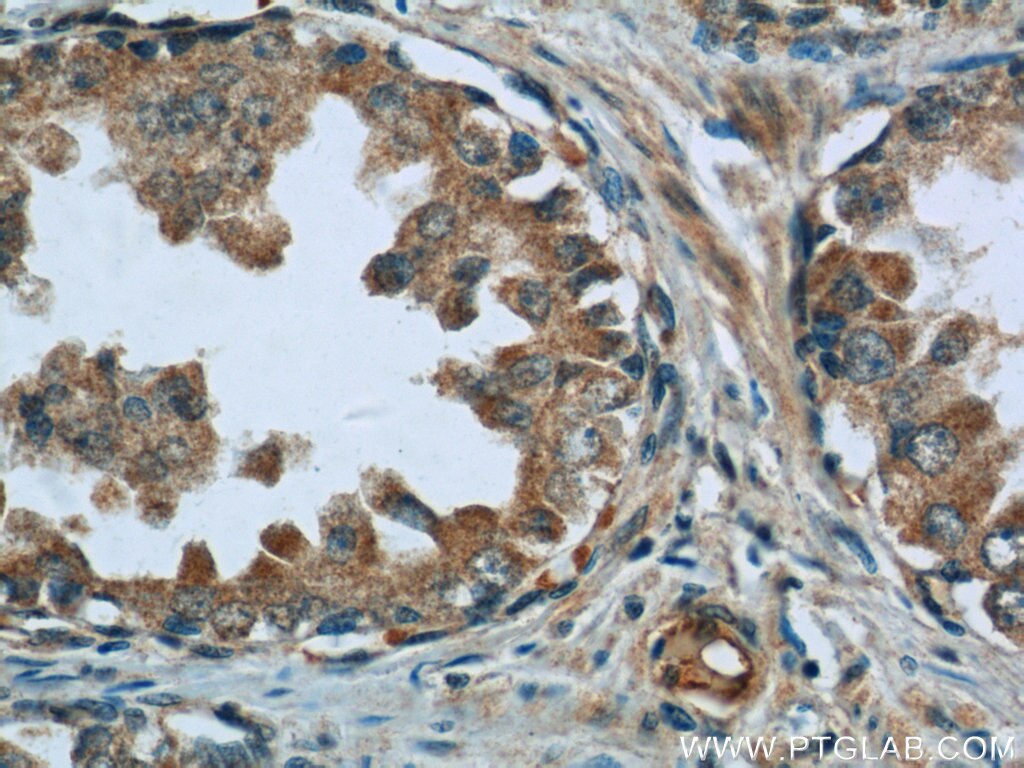 Immunohistochemistry (IHC) staining of human prostate cancer tissue using MAGEH1 Polyclonal antibody (12424-1-AP)