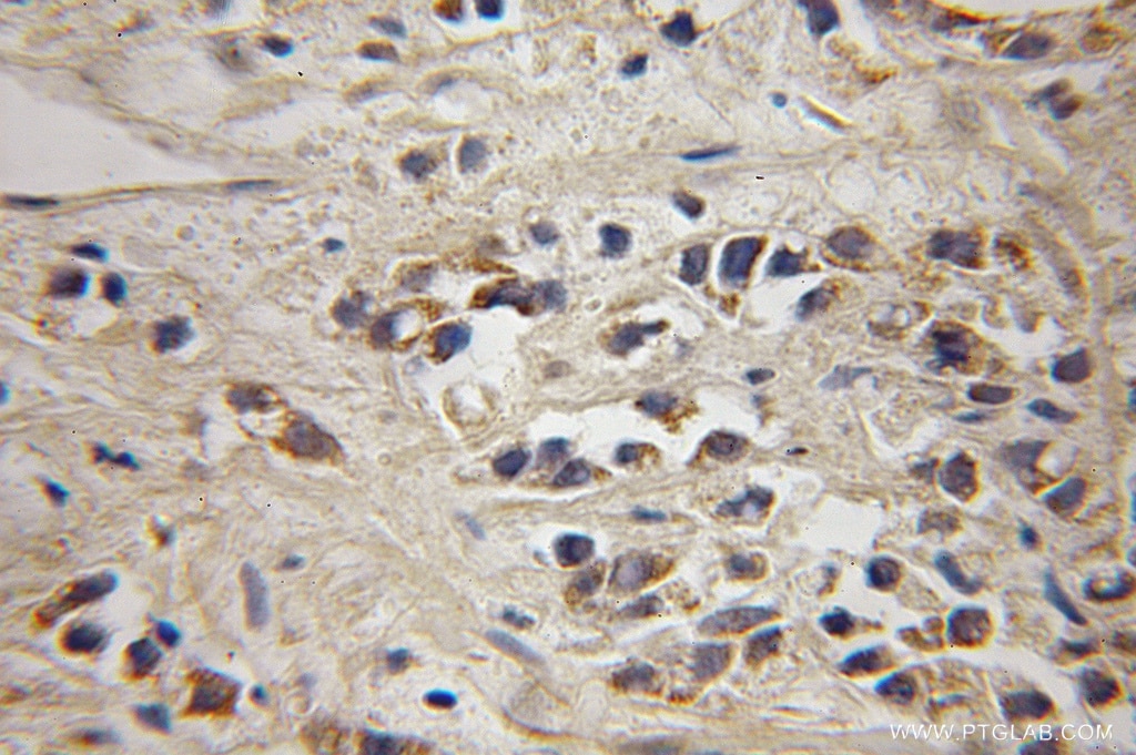 Immunohistochemistry (IHC) staining of human prostate cancer tissue using MAGEH1 Polyclonal antibody (12424-1-AP)