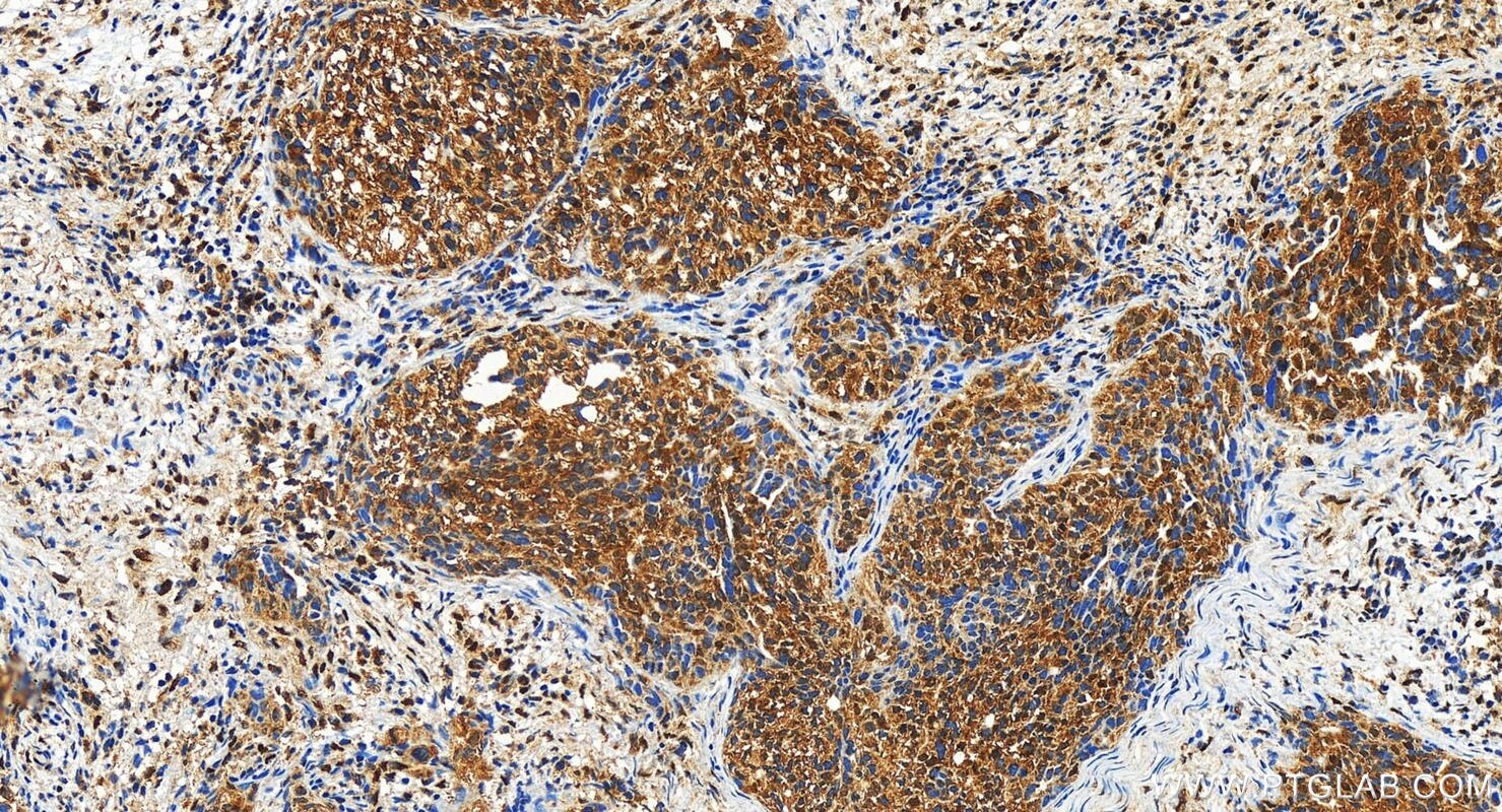 Immunohistochemistry (IHC) staining of human ovary cancer tissue using MAGI3 Polyclonal antibody (22615-1-AP)