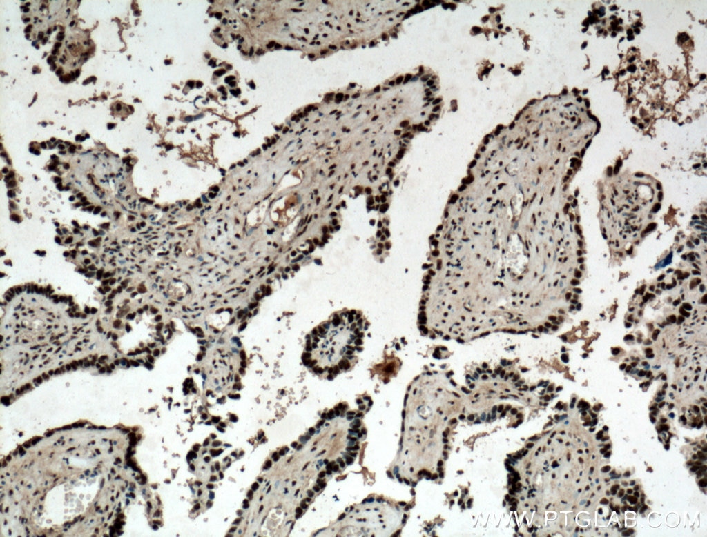 Immunohistochemistry (IHC) staining of human ovary tumor tissue using MAGOH Polyclonal antibody (12347-1-AP)