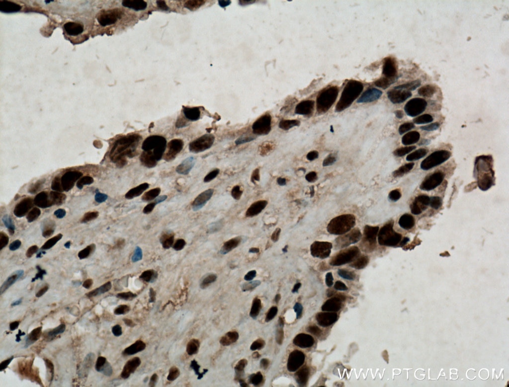 Immunohistochemistry (IHC) staining of human ovary tumor tissue using MAGOH Polyclonal antibody (12347-1-AP)