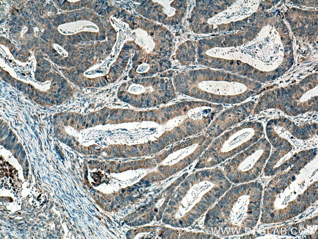 Immunohistochemistry (IHC) staining of human colon cancer tissue using MAGT1 Polyclonal antibody (17430-1-AP)