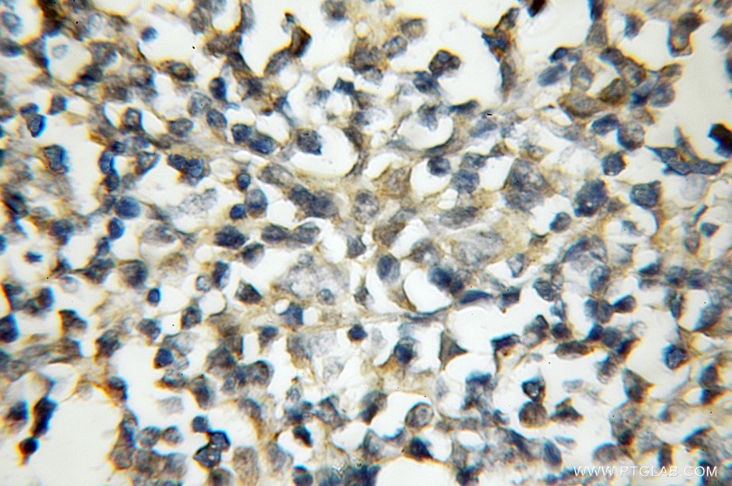 Immunohistochemistry (IHC) staining of human lymphoma tissue using MALT1 Polyclonal antibody (11660-1-AP)