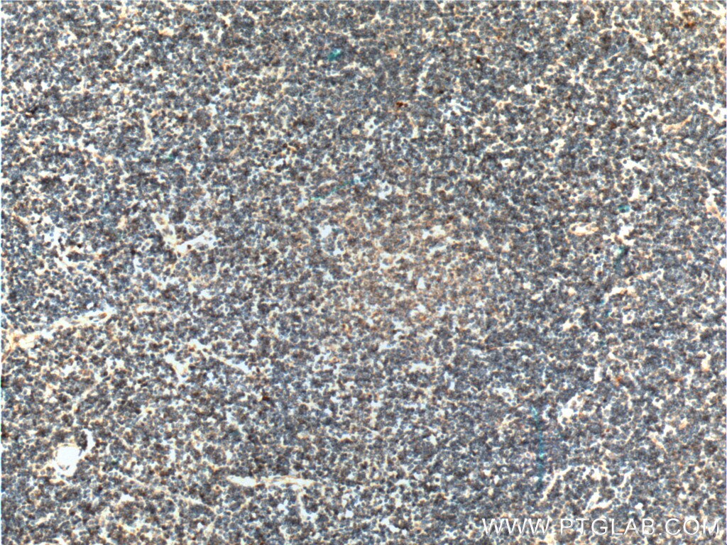 Immunohistochemistry (IHC) staining of human lymphoma tissue using MALT1 Monoclonal antibody (66225-1-Ig)