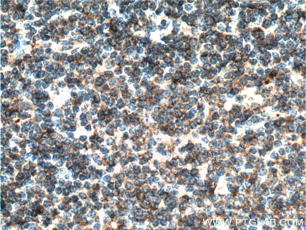 Immunohistochemistry (IHC) staining of human lymphoma tissue using MALT1 Monoclonal antibody (66225-1-Ig)