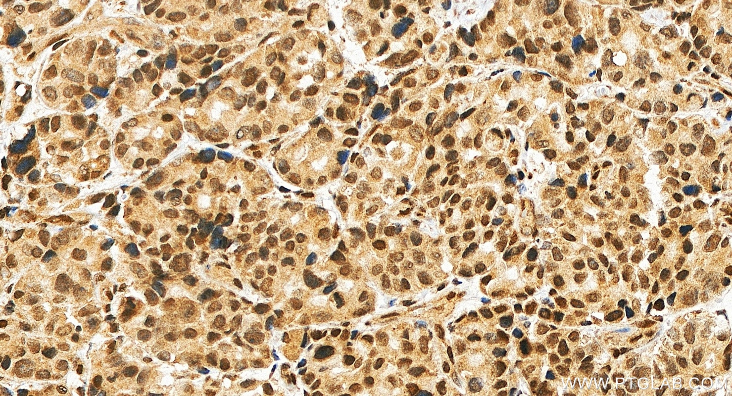IHC staining of human stomach cancer using 23263-1-AP Immunohistochemistry (IHC) staining of human stomach cancer tissue using MAML3 Polyclonal antibody (23263-1-AP)