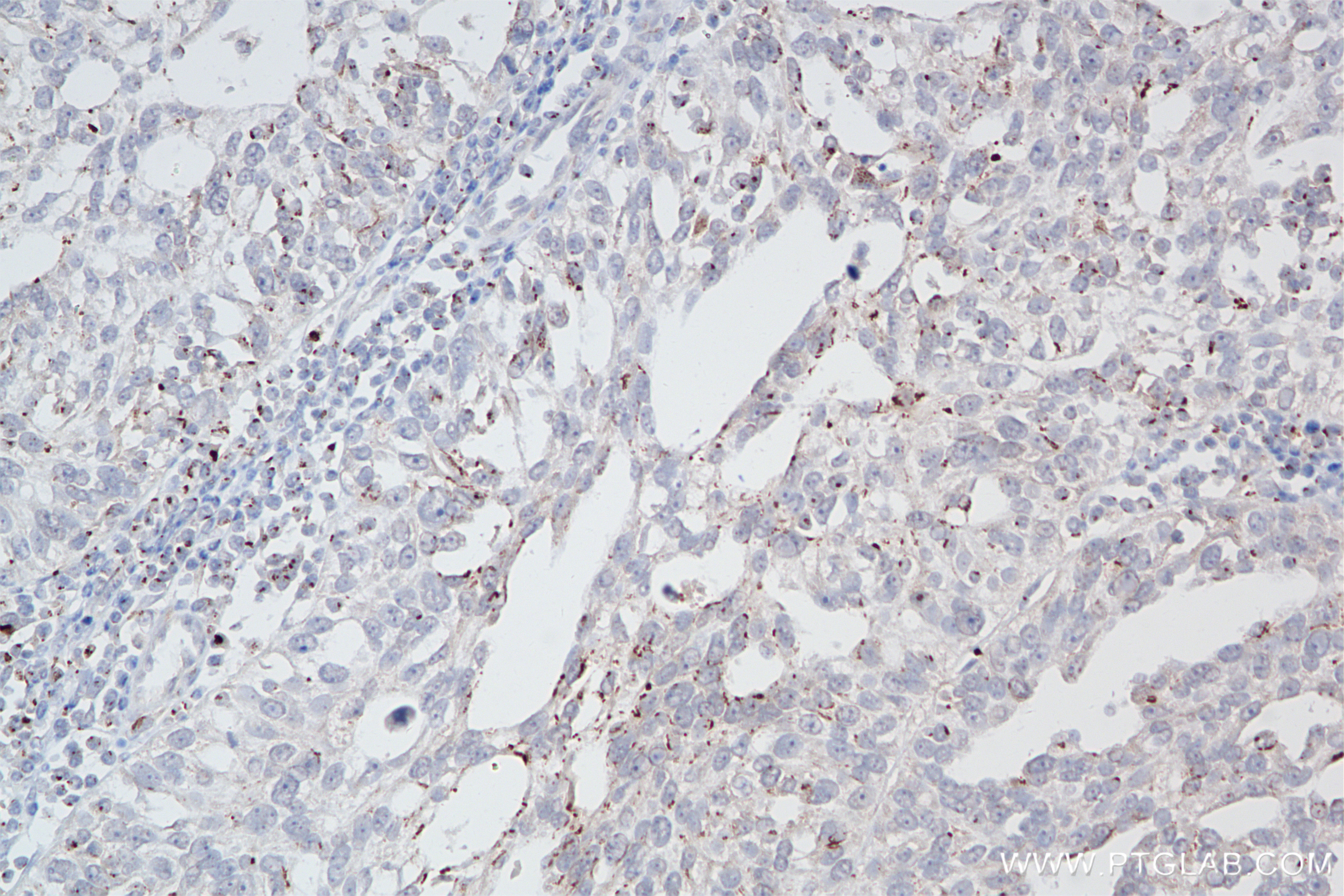 Immunohistochemistry (IHC) staining of human ovary cancer tissue using MAN1A1 Recombinant antibody (86094-1-RR)