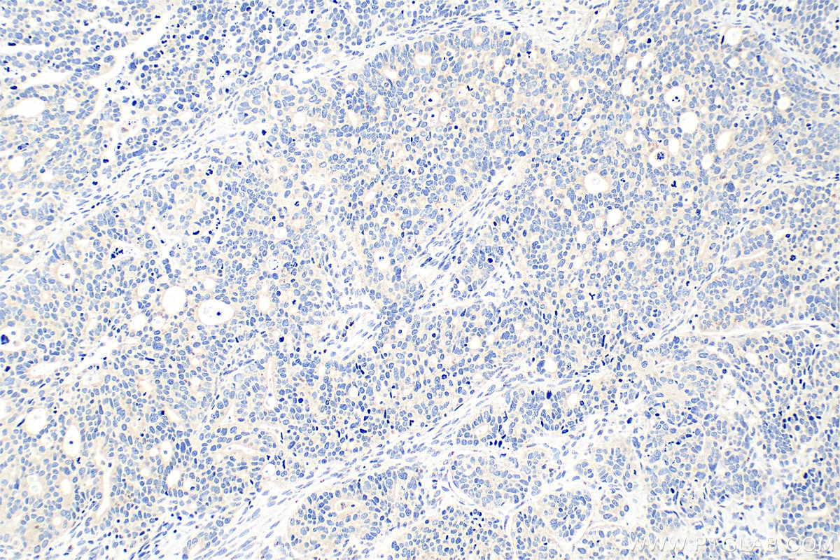 Immunohistochemistry (IHC) staining of human ovary tumor tissue using Biotin-conjugated MAN1A1 Polyclonal antibody (Biotin-23382)