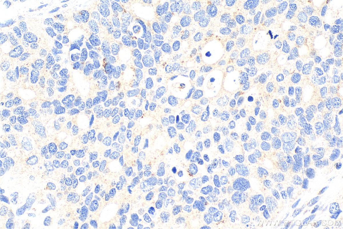 Immunohistochemistry (IHC) staining of human ovary tumor tissue using Biotin-conjugated MAN1A1 Polyclonal antibody (Biotin-23382)