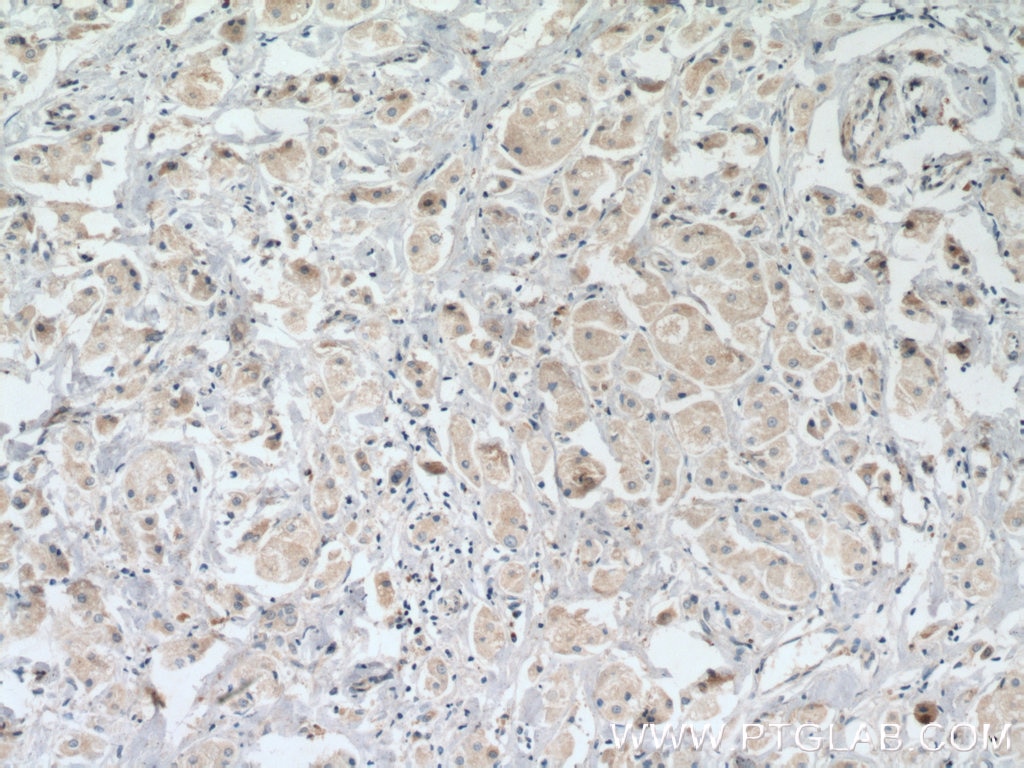 Immunohistochemistry (IHC) staining of human breast cancer tissue using MANEA Polyclonal antibody (21296-1-AP)