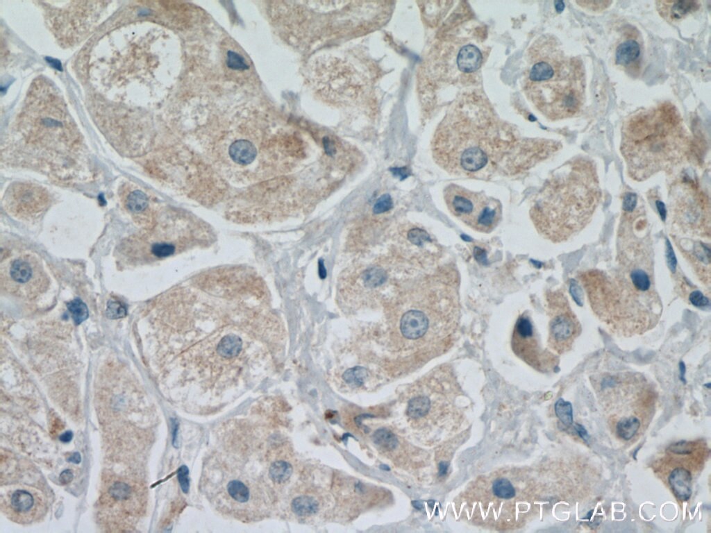 Immunohistochemistry (IHC) staining of human breast cancer tissue using MANEA Polyclonal antibody (21296-1-AP)