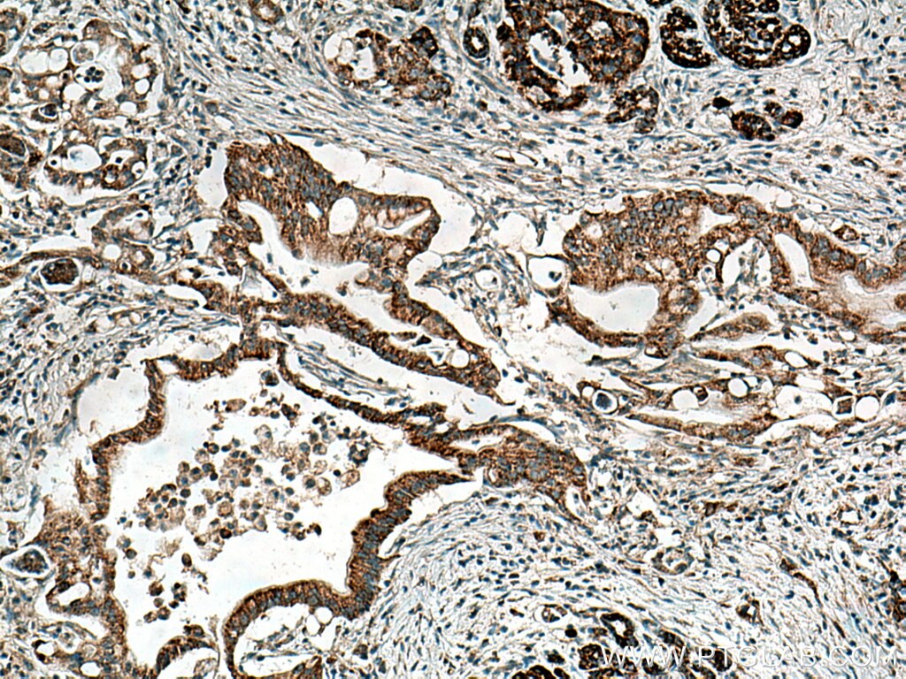 Immunohistochemistry (IHC) staining of human pancreas cancer tissue using MAOA Polyclonal antibody (10539-1-AP)