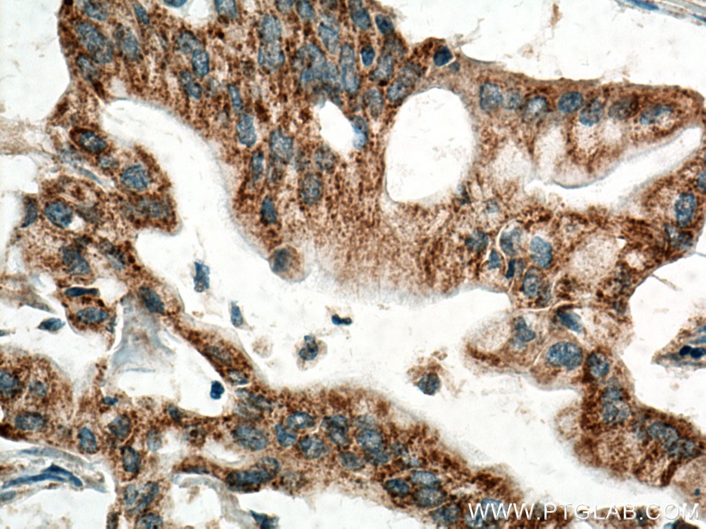 Immunohistochemistry (IHC) staining of human pancreas cancer tissue using MAOA Polyclonal antibody (10539-1-AP)