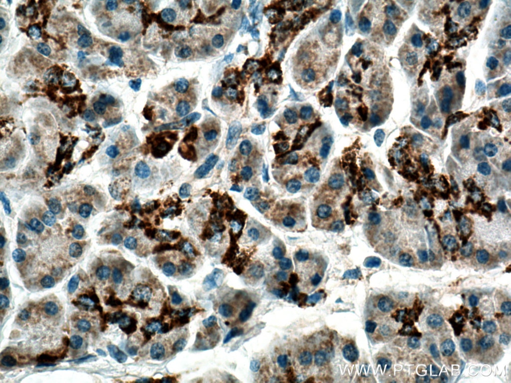 Immunohistochemistry (IHC) staining of human pancreas cancer tissue using MAOA Polyclonal antibody (10539-1-AP)