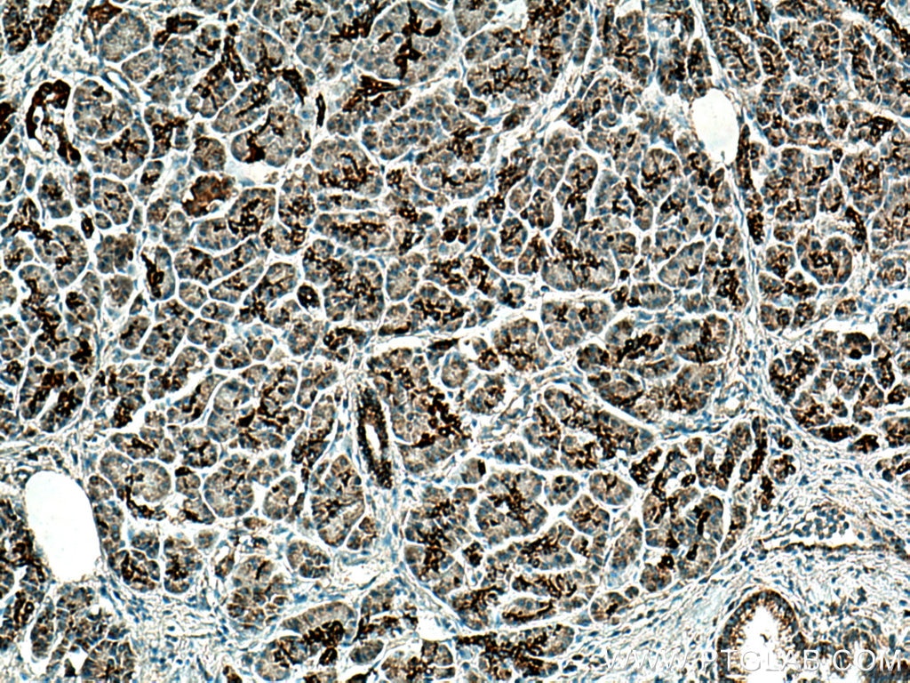 Immunohistochemistry (IHC) staining of human pancreas cancer tissue using MAOA Polyclonal antibody (10539-1-AP)
