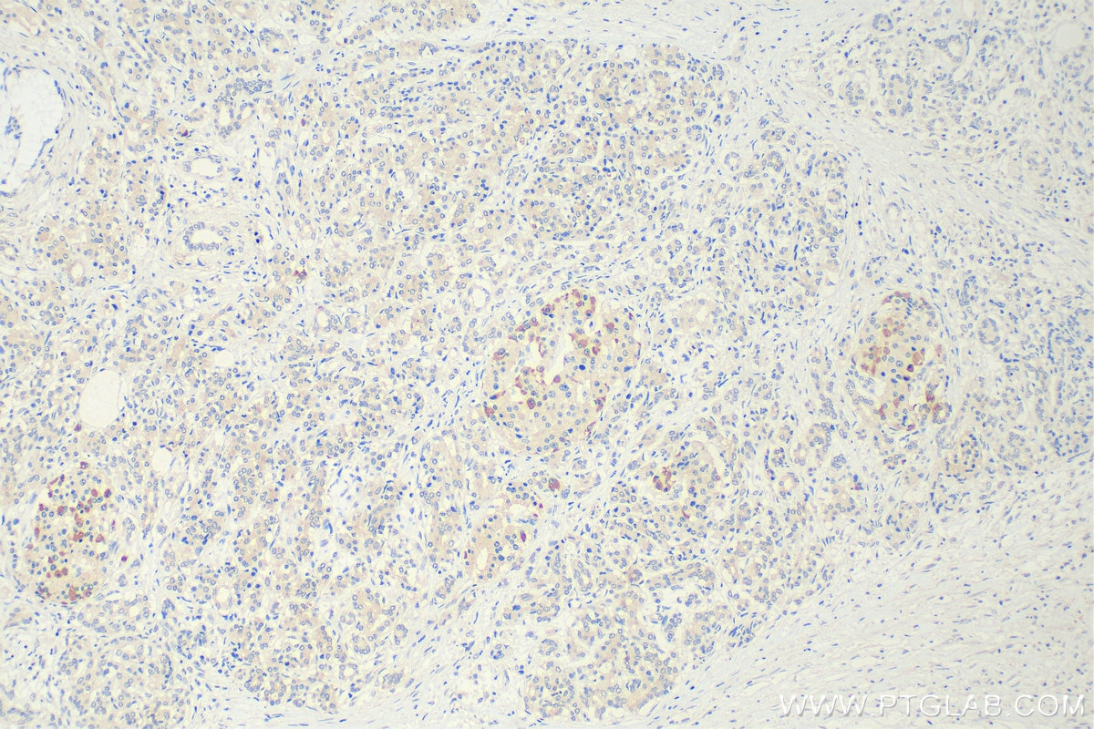 IHC staining of human pancreas cancer using 68471-1-Ig