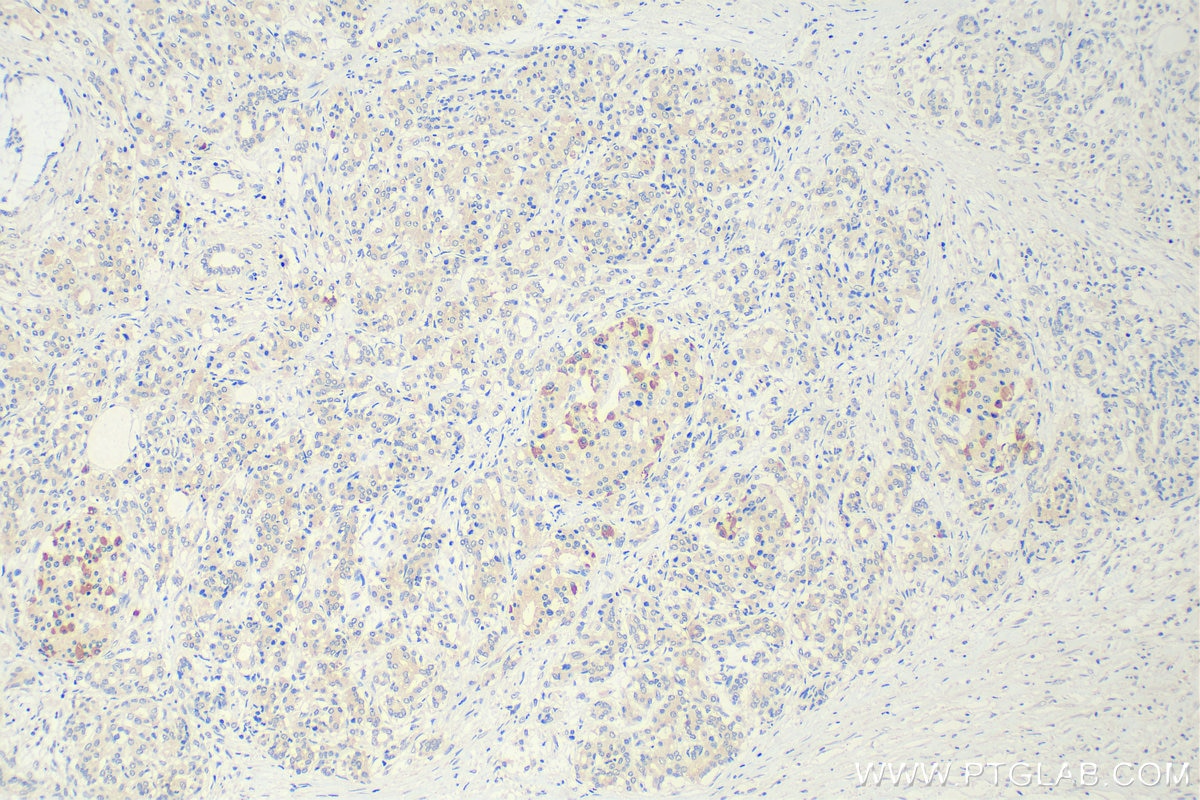 Immunohistochemistry (IHC) staining of human pancreas cancer tissue using MAOA Monoclonal antibody (68471-1-Ig)