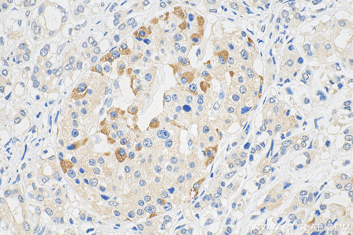 Immunohistochemistry (IHC) staining of human pancreas cancer tissue using MAOA Monoclonal antibody (68471-1-Ig)