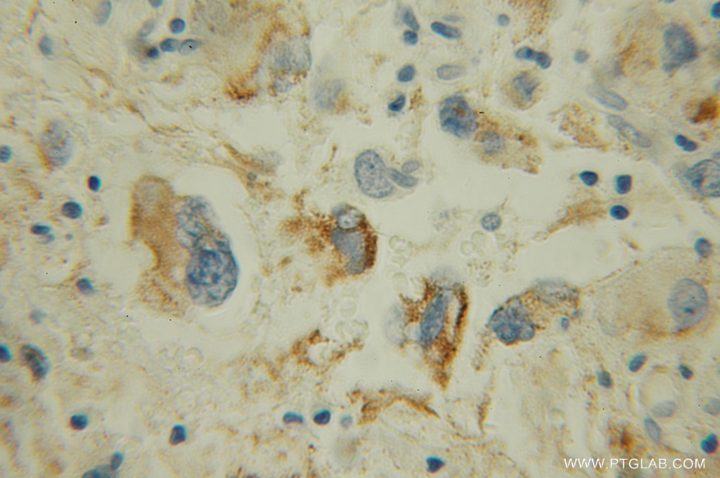 Immunohistochemistry (IHC) staining of human gliomas tissue using MAOB Polyclonal antibody (12602-1-AP)