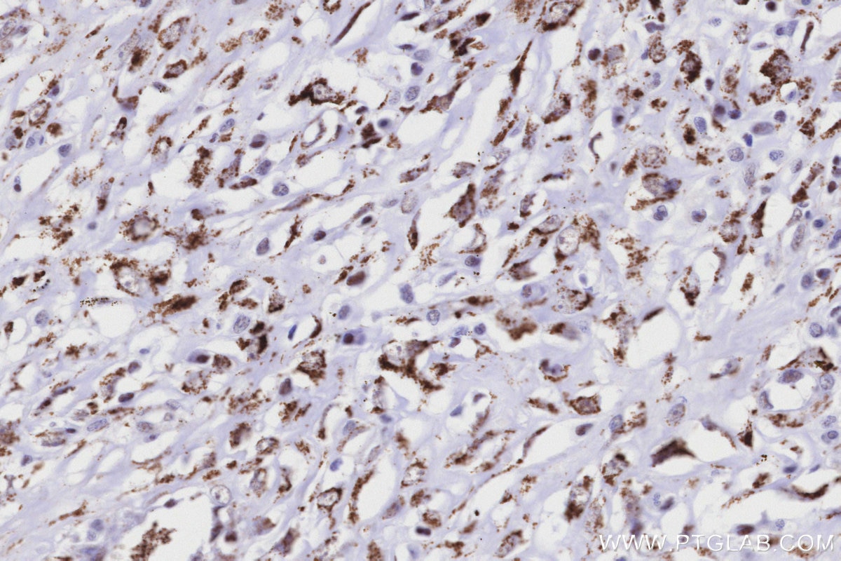 Immunohistochemistry (IHC) staining of human colon cancer tissue using MAOB Recombinant monoclonal antibody (86695-1-RR)