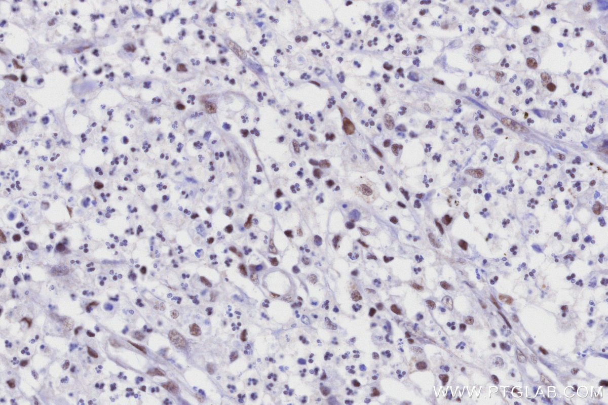 Immunohistochemistry (IHC) staining of human colon cancer tissue using MAOB Recombinant monoclonal antibody (86695-1-RR)