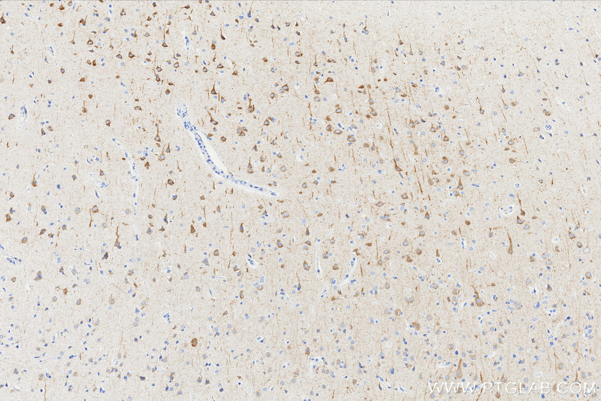 IHC staining of Human brain cancer(Astrocitoma) using 87623-1-RR (same clone as 87623-1-PBS) Immunohistochemistry (IHC) staining of Human brain cancer(Astrocitoma) using MAP1A Recombinant monoclonal antibody (87623-1-RR)