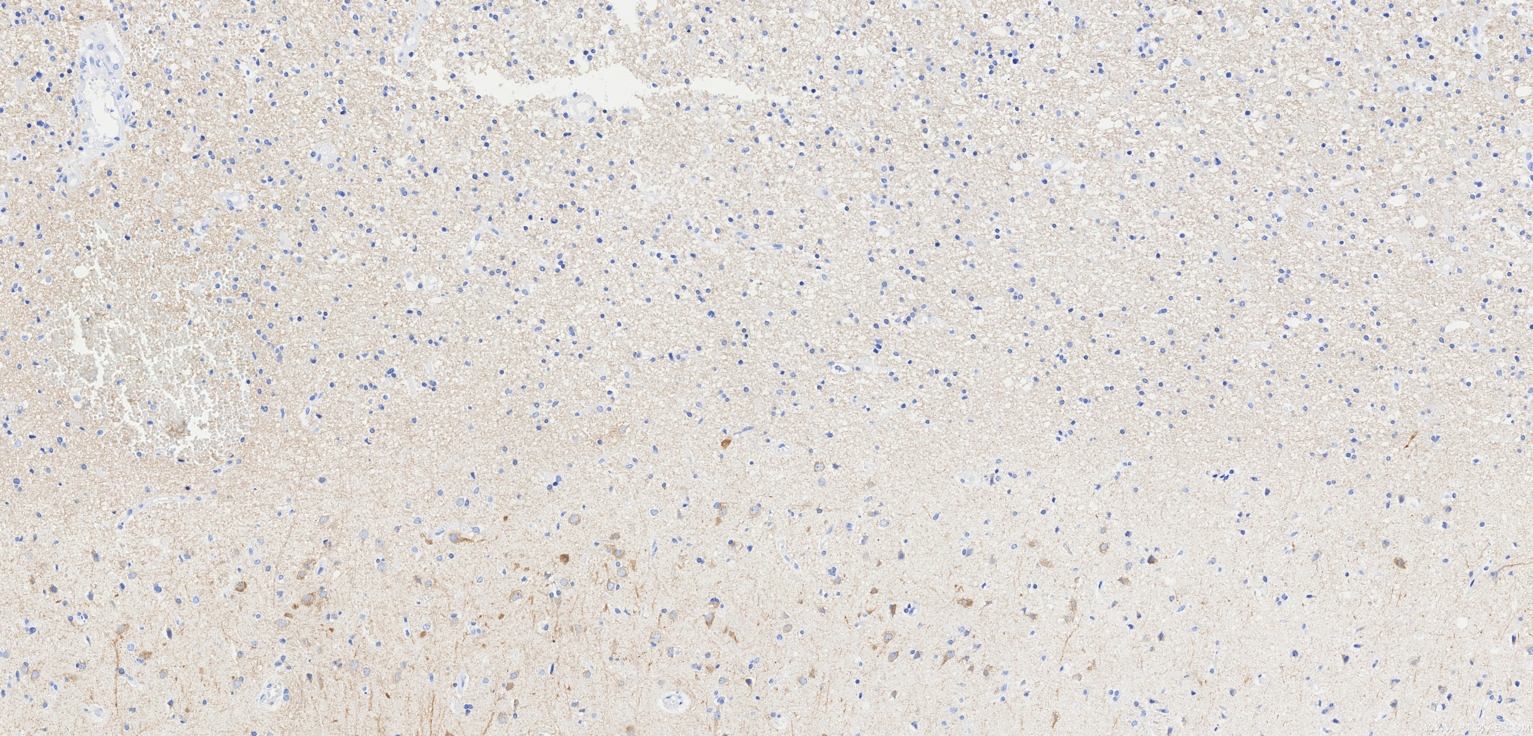 IHC staining of Human brain cancer(Astrocitoma) using 87623-1-RR (same clone as 87623-1-PBS) Immunohistochemistry (IHC) staining of Human brain cancer(Astrocitoma) using MAP1A Recombinant monoclonal antibody (87623-1-RR)
