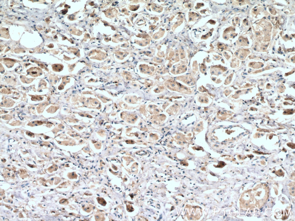 Immunohistochemistry (IHC) staining of human breast cancer tissue using LC3 Polyclonal antibody (12135-1-AP)