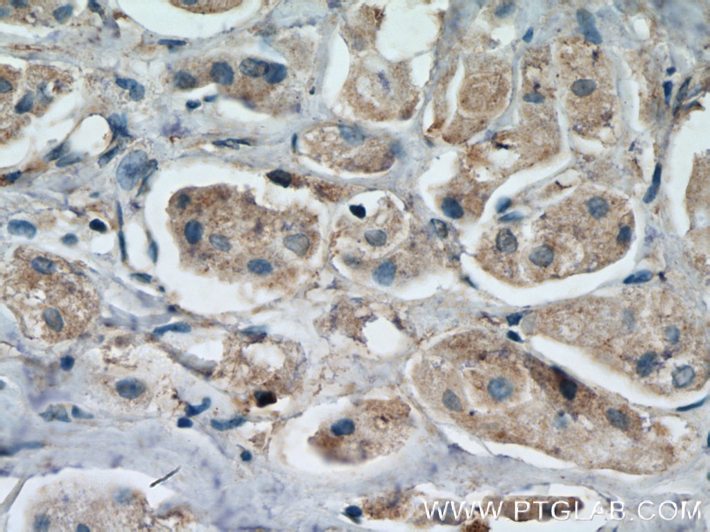 Immunohistochemistry (IHC) staining of human breast cancer tissue using LC3 Polyclonal antibody (12135-1-AP)