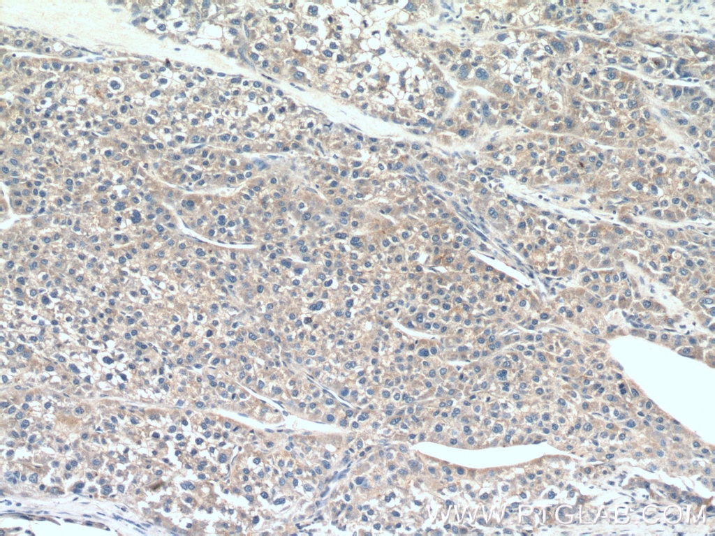 IHC staining of human liver cancer using 12135-1-AP