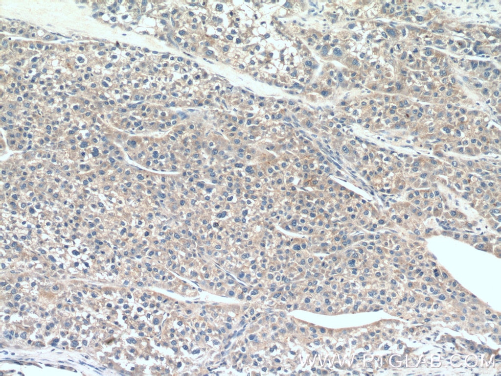 Immunohistochemistry (IHC) staining of human liver cancer tissue using LC3 Polyclonal antibody (12135-1-AP)