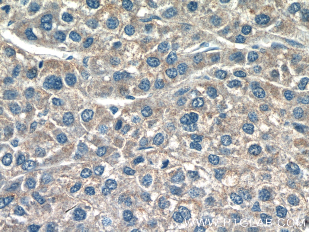 Immunohistochemistry (IHC) staining of human liver cancer tissue using LC3 Polyclonal antibody (12135-1-AP)