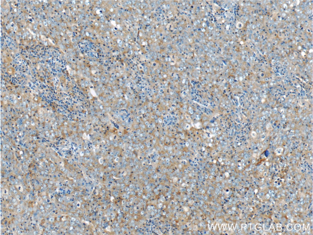 Immunohistochemistry (IHC) staining of human breast cancer tissue using LC3 Polyclonal antibody (14600-1-AP)